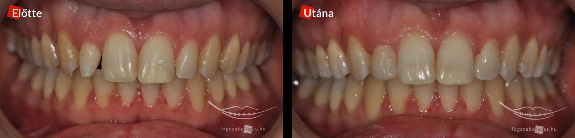 Aszimetrikus kismetsző fogak ellátása 24 éves nő páciens a jobb felső kettes, illetve a bal felső kettes foga kompozit tömőanyaggal lett kiegészítve.