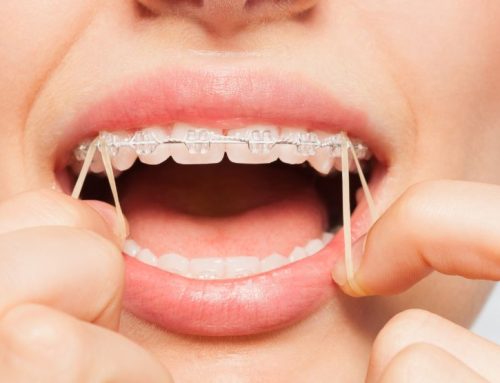 Extra segítség a fogszabályozás során:  Elasztikus gumihúzás