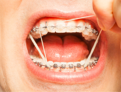 Mi a célja az intermaxilláris gumihúzásnak a fogszabályozásban?