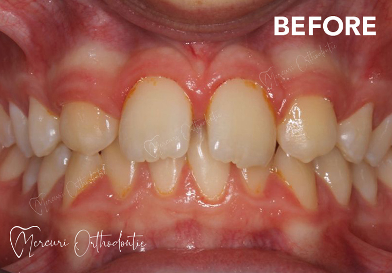 Before image alt
