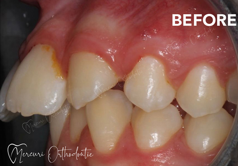 Before image alt