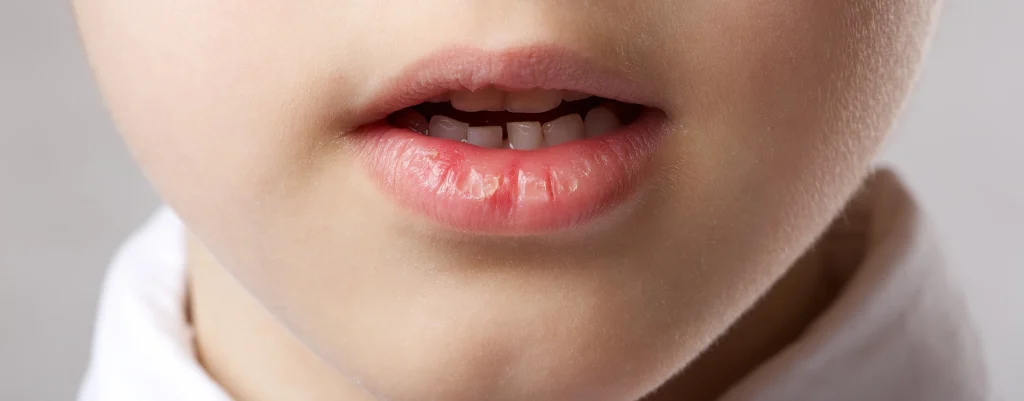 Nyelvlökéses nyelés logopédiai terápia