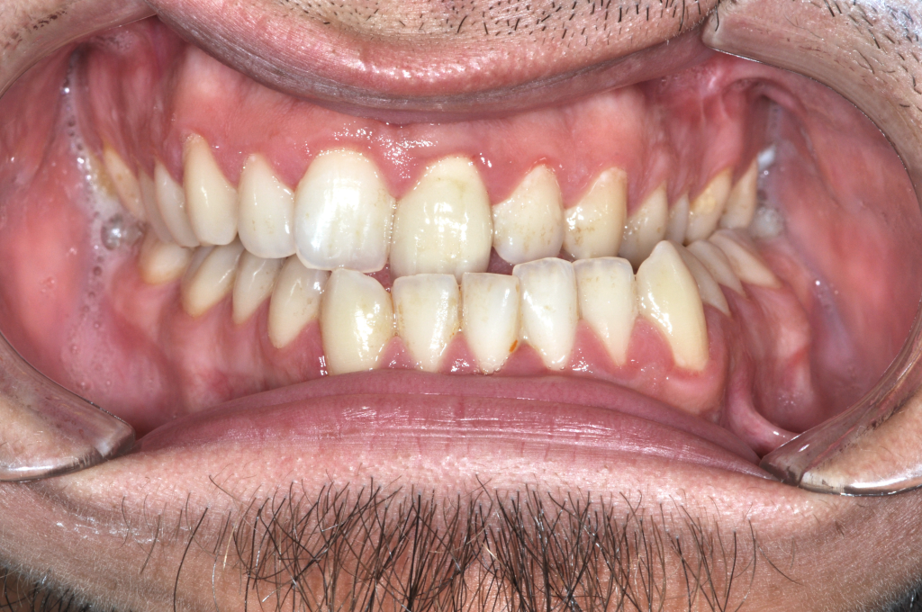 Előtte fogsor - Állcsonti aszimmetria kezelése