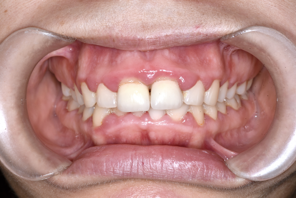 Előtte fogsor - Ínymosoly műtéti megoldása​