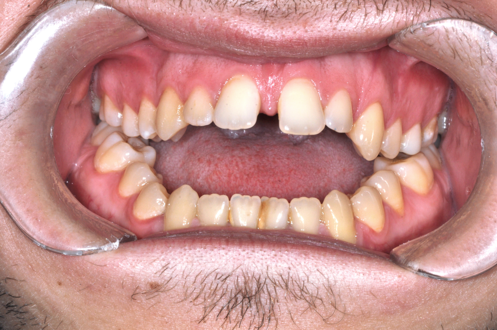 Előtte fogsor - Nyitott harapás kezelése állcsontműtéttel