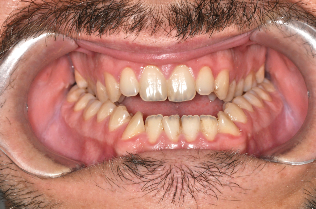 Előtte fogsor - Bulldogharapás + nyitott harapás kombinált kezelése