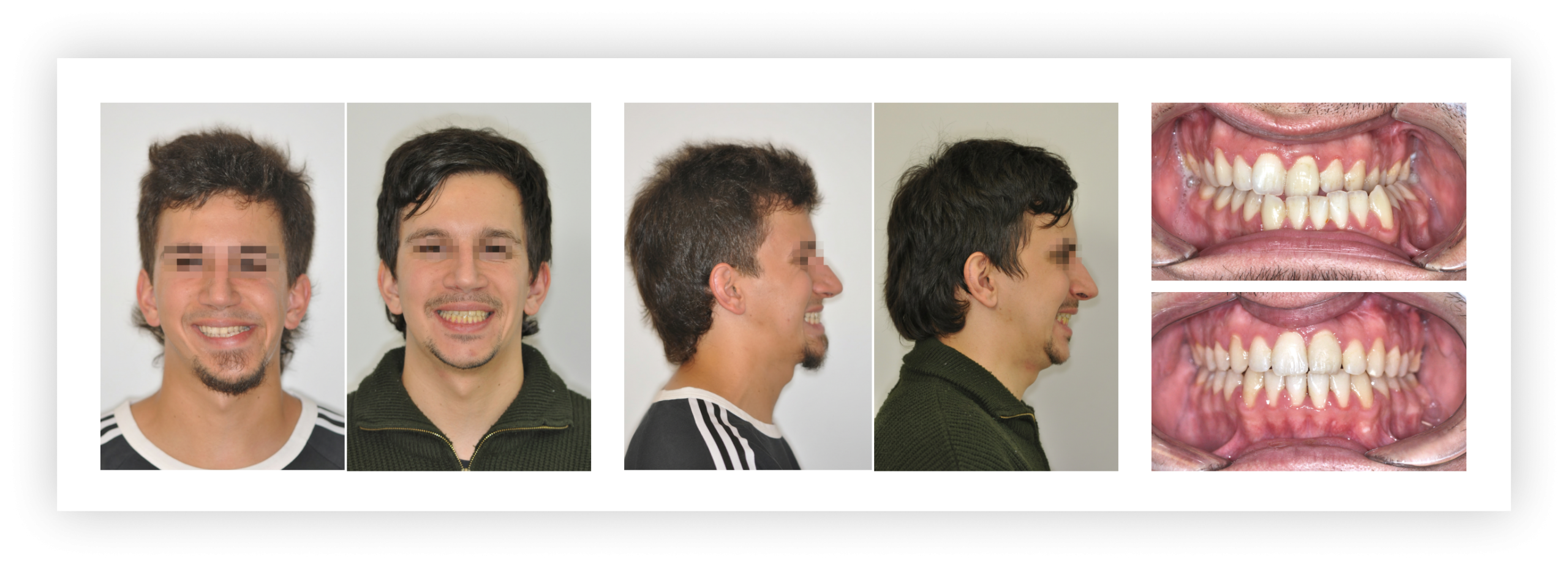 Állcsonti aszimmetria kezelése