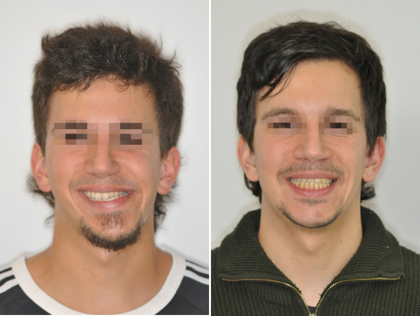 Állcsonti aszimmetria kezelése