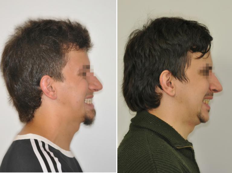 Állcsonti aszimmetria kezelése