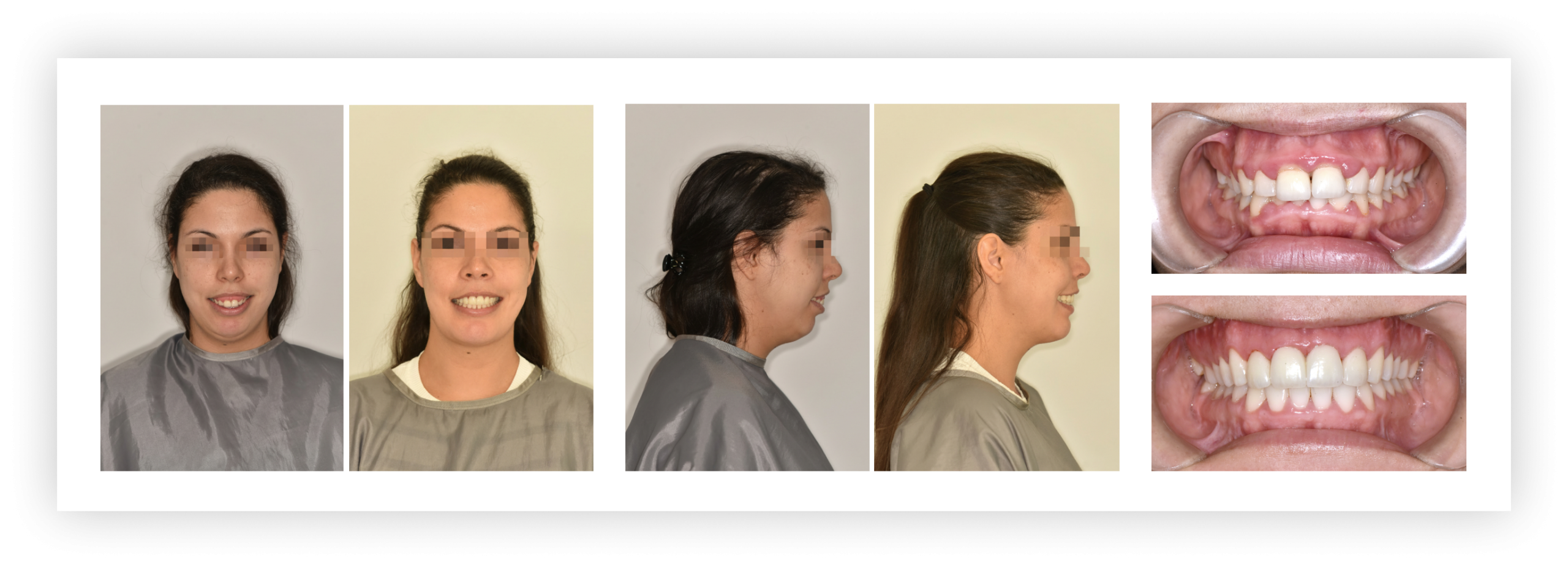 Ínymosoly műtéti megoldása