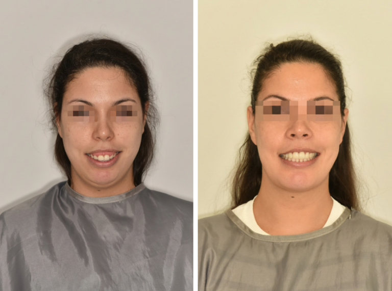 Ínymosoly műtéti megoldása