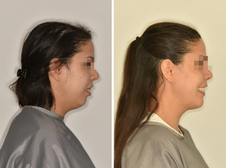 Ínymosoly műtéti megoldása