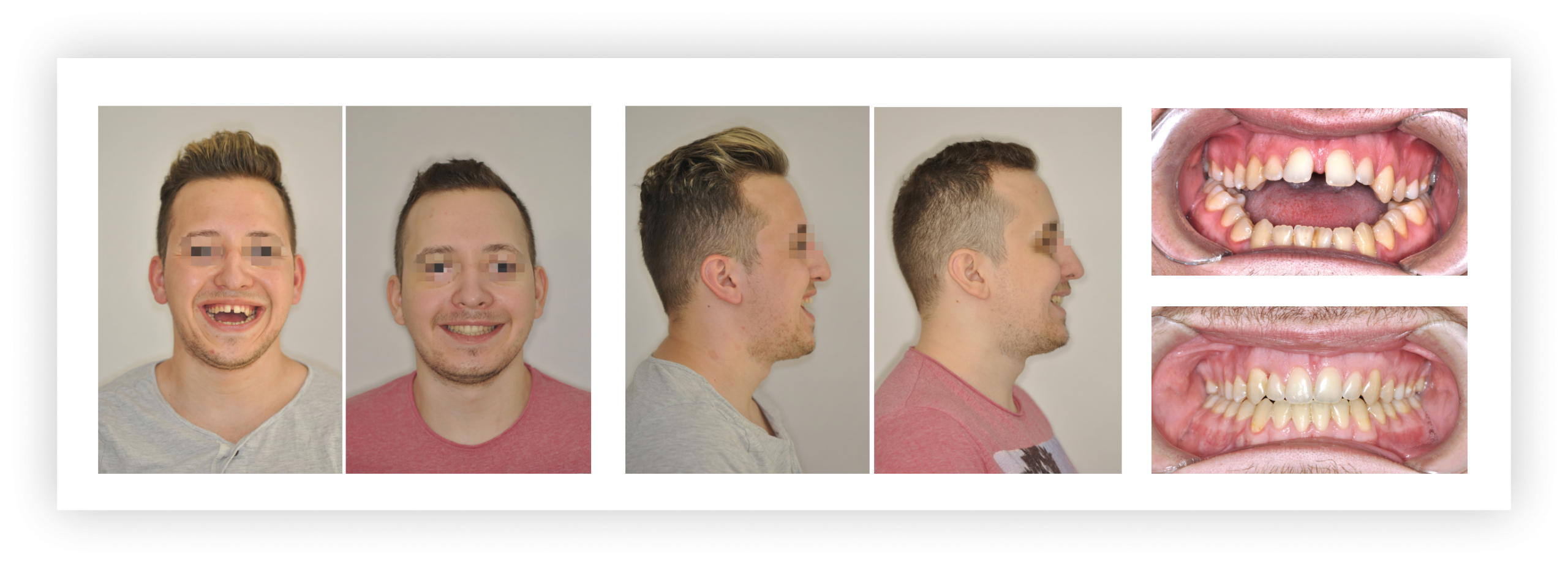 Nyitott harapás kezelése állcsontműtéttel