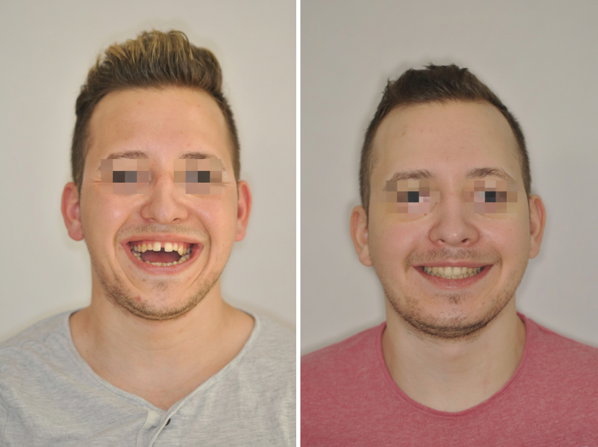 Nyitott harapás kezelése állcsontműtéttel