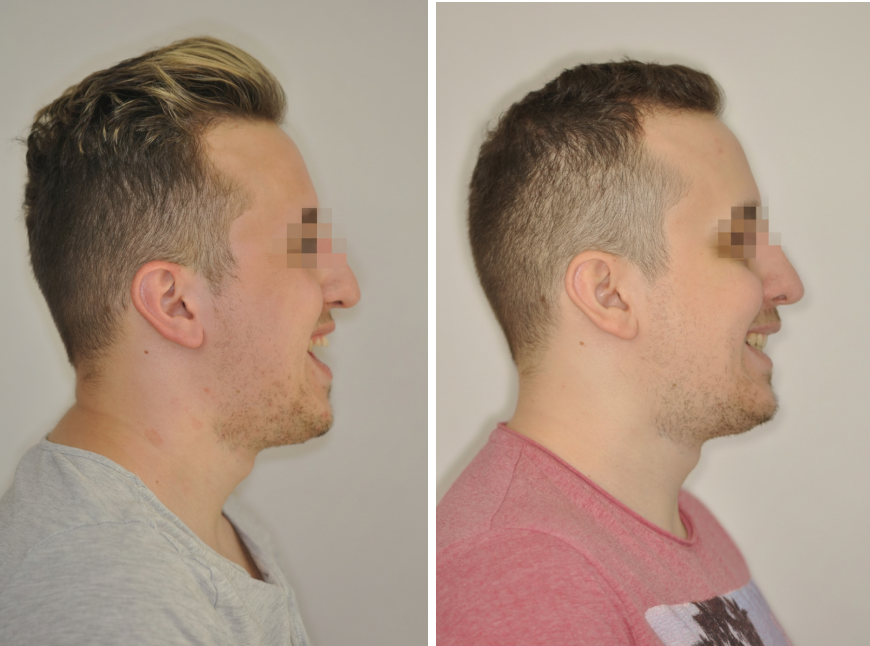 Nyitott harapás kezelése állcsontműtéttel