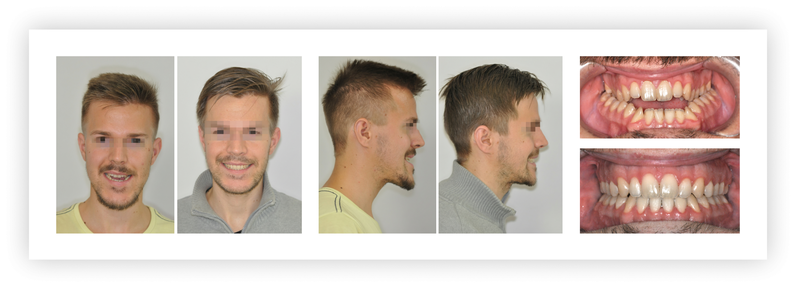 Bulldogharapás + nyitott harapás kombinált kezelése