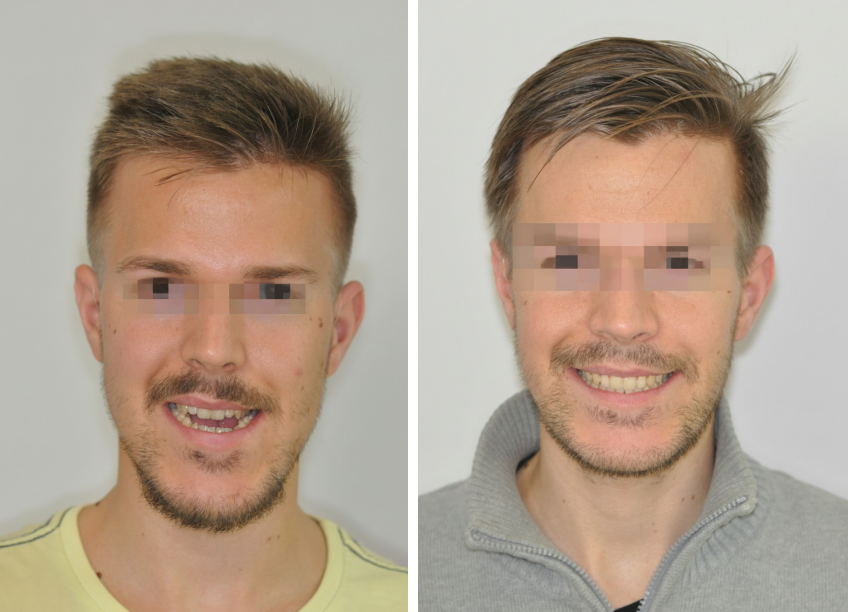 Bulldogharapás + nyitott harapás kombinált kezelése