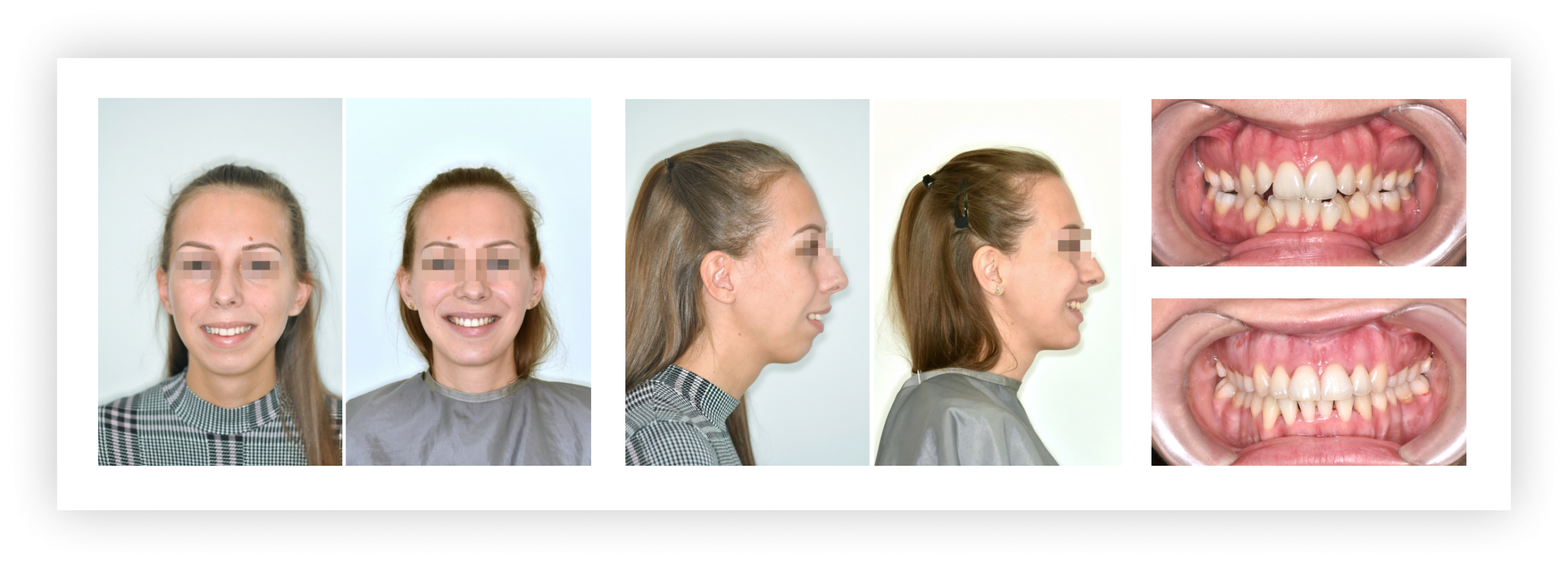 Prognathiás eltérés – komplex állcsonti korrekció​