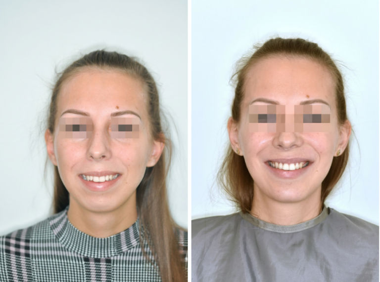 Prognathiás eltérés – komplex állcsonti korrekció