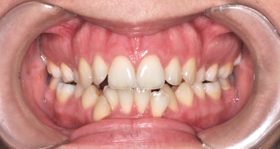 Prognathiás eltérés – komplex állcsonti korrekció - utána