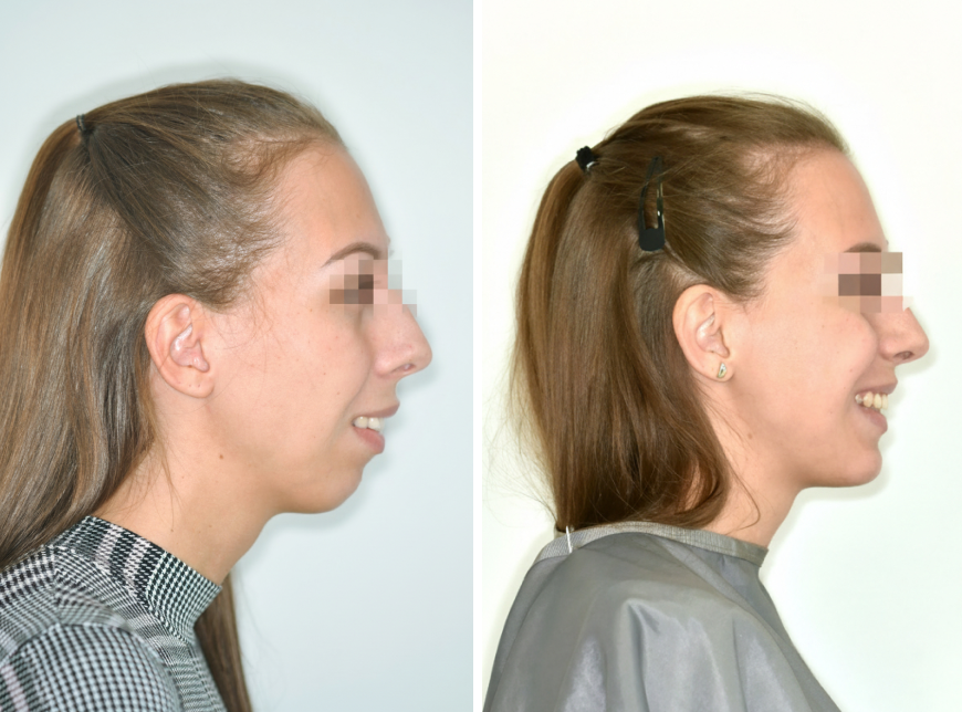 Prognathiás eltérés – komplex állcsonti korrekció​