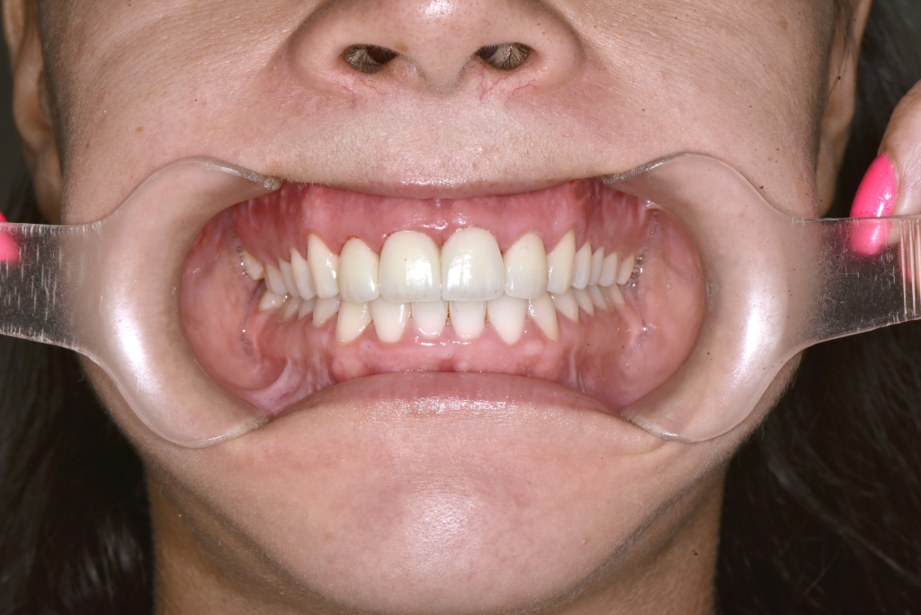 Utána fogsor - Ínymosoly műtéti megoldása​