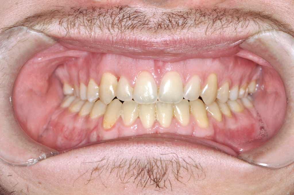 Utána fogsor - Nyitott harapás kezelése állcsontműtéttel