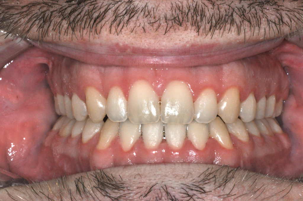 Utána fogsor - Bulldogharapás + nyitott harapás kombinált kezelése